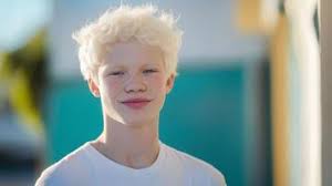 Effects of Sunlight on Health 1 effects of sunlight on health as potrayed by albino people