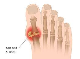 Medical illustration of uric acid crystals in the big toe joint, showing painful uric acid effects like gout caused by excess purine breakdown.