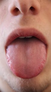 Close-up of a human tongue and mouth showing oral health indicators for interpreting signs and symptoms at home