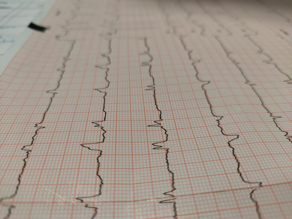 A cardiology ECG monitor displaying the abnormal rhythm of a heart attack, a condition that critically impacts heart function and overall vital capacity.