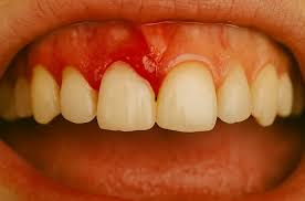 close-up image of red, bleeding gums next to white teeth, illustrating a symptom linked to poor legumes nutrition and digestion from improper cooking methods. Close-up showing red, spongy, and bleeding gums, illustrating a potential symptom of systemic imbalance from poor legumes nutrition and digestion.